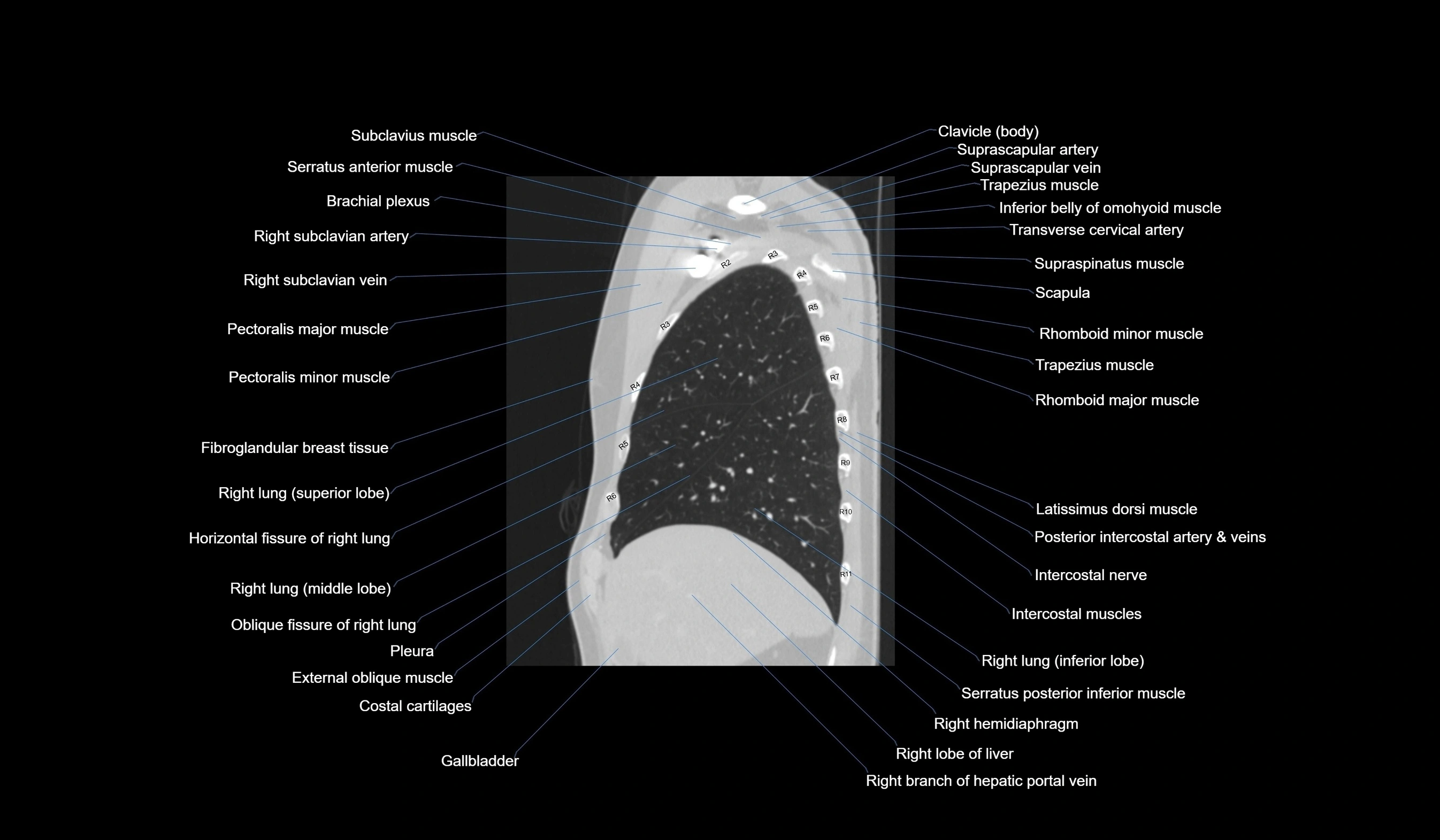 CT chest (thorax) lung window labelled sagittal cross sectional anatomy radiology image-00036.webp